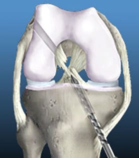 Procedimientos ortopédicos de rodilla
