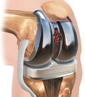 Procedimientos ortopédicos de rodilla
