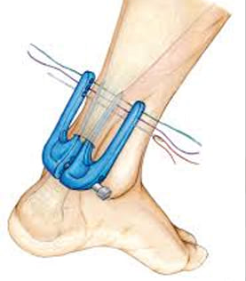 Procedimientos ortopédicos de pies y tobillos
