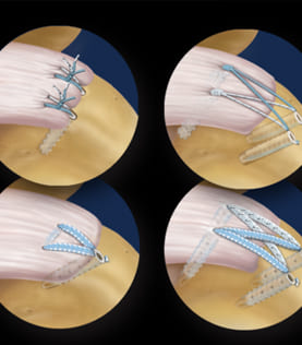 Procedimientos ortopédicos de hombro